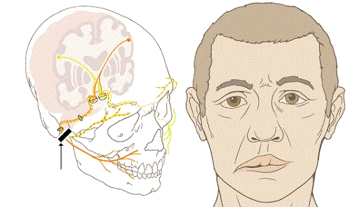 Dây thần kinh số VII