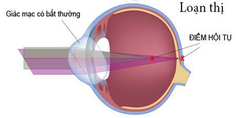 giác mạc biến dạng