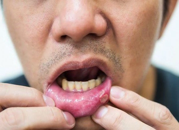 lở miệng HIV