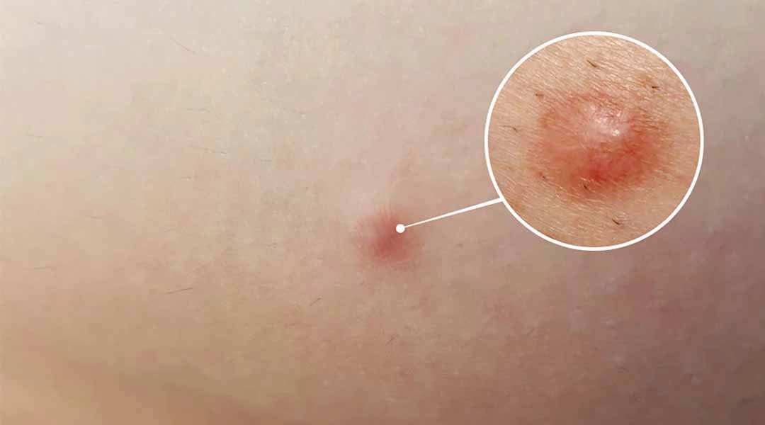 nổi cục cứng nhỏ dưới da