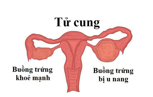 Nang buồng trứng chức năng