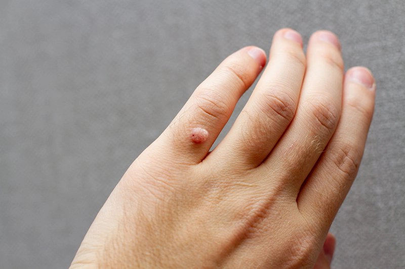 các loại mụn mọc ở tay