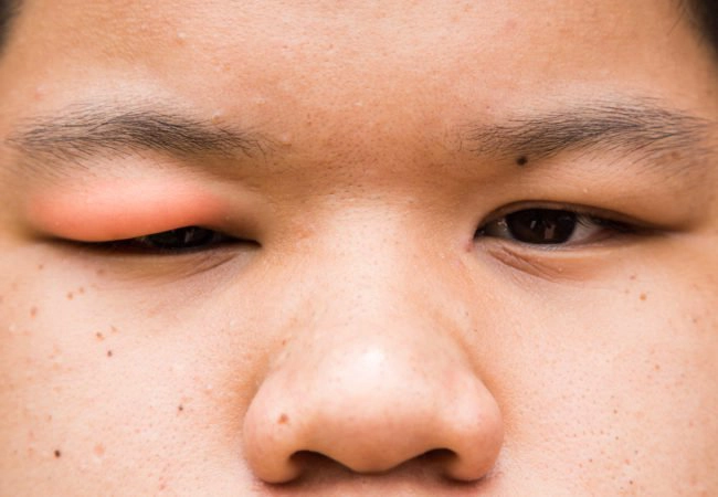 mặt bị sưng phù