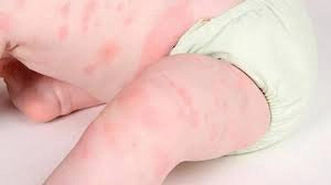 trẻ bị nổi mẩn đỏ như muỗi đốt