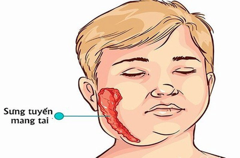 Mắc quai bị rồi liệu có bị lại nữa không?