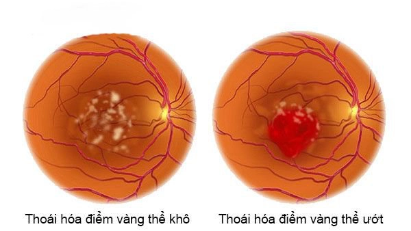 Thoái hóa điểm vàng gồm những loại nào?