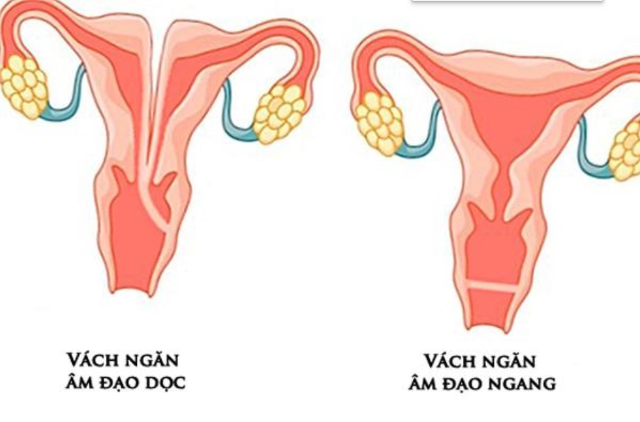 Âm đạo có vách ngăn
