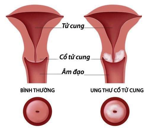 Ung thư cổ tử cung có thể sinh con được không?