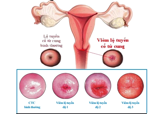 Viêm lộ tuyến