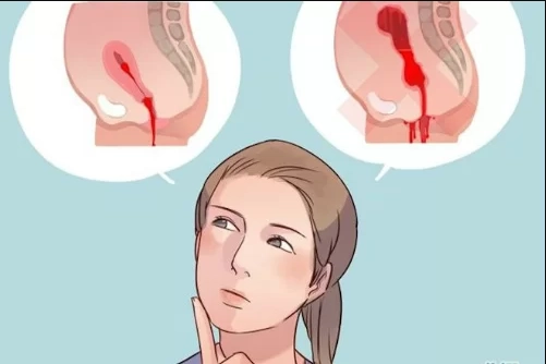 Chảy máu âm đạo sau khi sinh: Khi nào cần gọi bác sĩ? (Phần 2)
