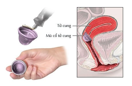 Thực hiện lắp mũ cổ tử cung