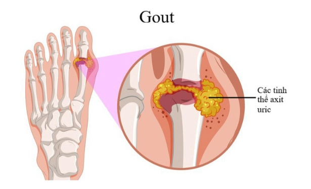 Bệnh gout
