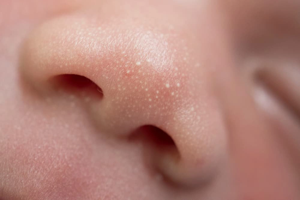 bé sơ sinh nổi mụn sữa