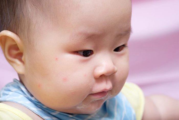 Mụn sữa ở trẻ sơ sinh