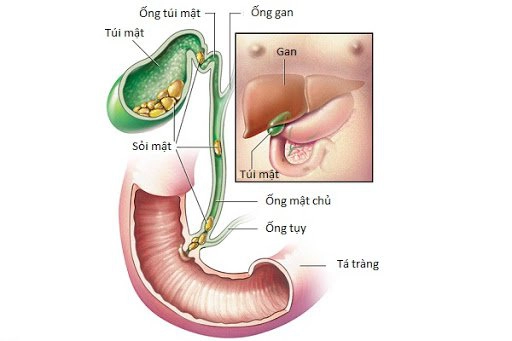 Tắc nghẽn tá tràng và ống mật chủ