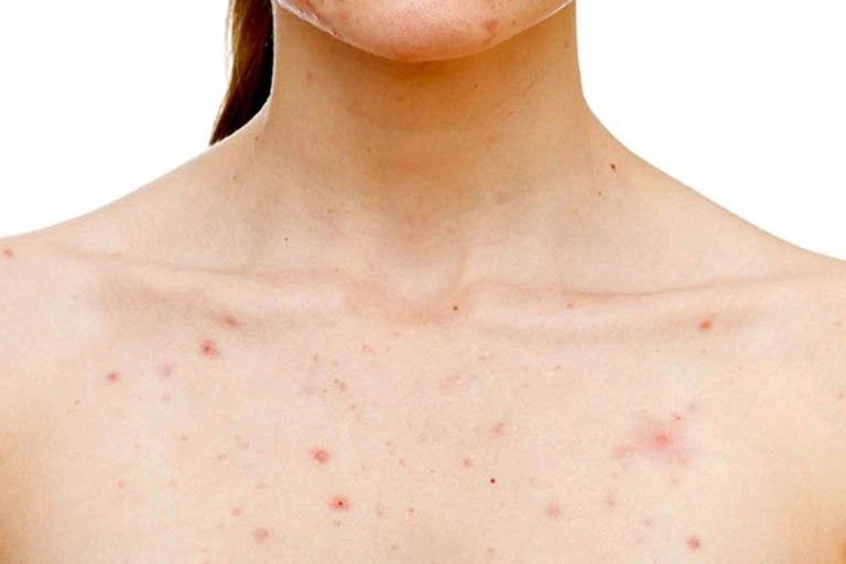 Viêm nang lông là một biểu hiện của tắc lỗ chân lông
