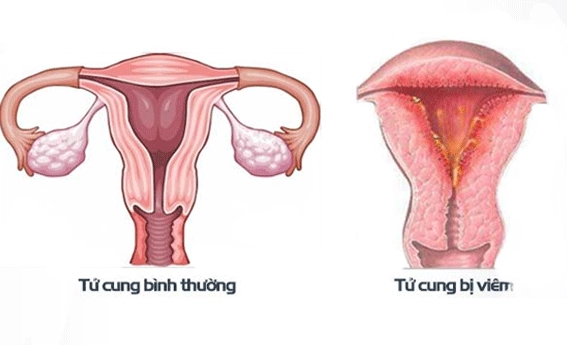 viêm nội mạc tử cung