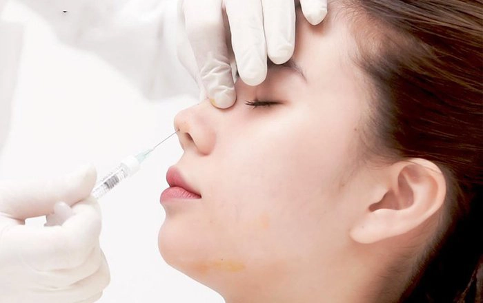 Nên nâng mũi bằng chỉ hay tiêm filler