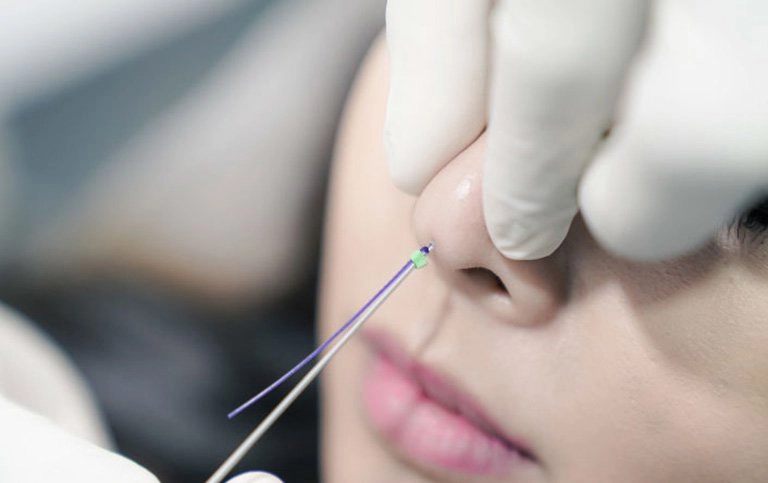 Nên nâng mũi bằng chỉ hay tiêm filler