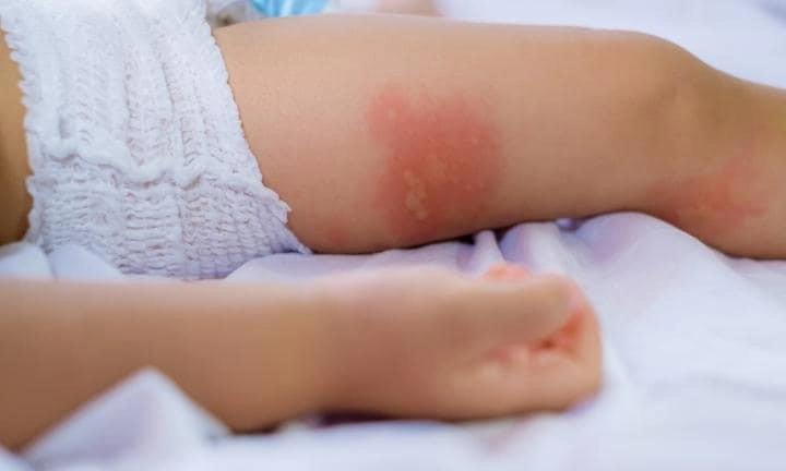 vết muỗi đốt