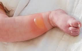 vết muỗi đốt
