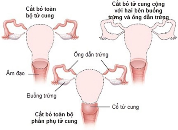 Các phương pháp cắt bỏ tử cung