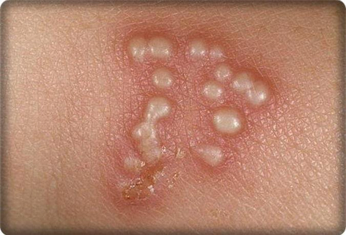 Mụn rộp sinh dục là một trong các loại mụn ở vùng kín thường gặp