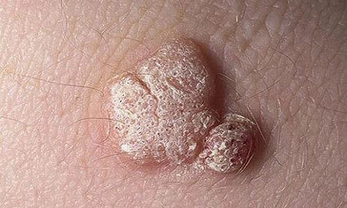 Mụn cóc sinh dục ở vùng kín thường do virus u nhú ở người (HPV) gây ra