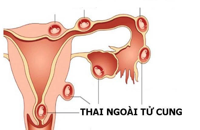 buốt cửa mình khi mang thai tháng đầu