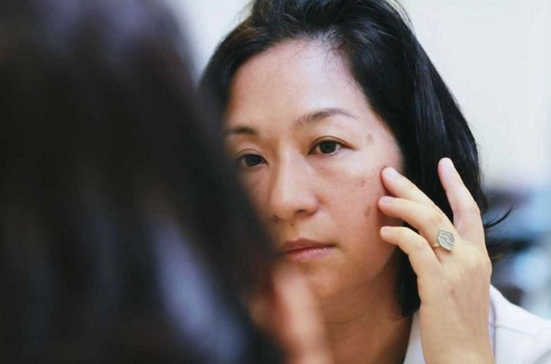 nguyên nhân gây nám da ở phụ nữ