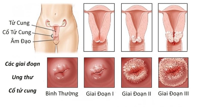 Nguyên nhân gây ra bệnh ung thư cổ tử cung là gì?