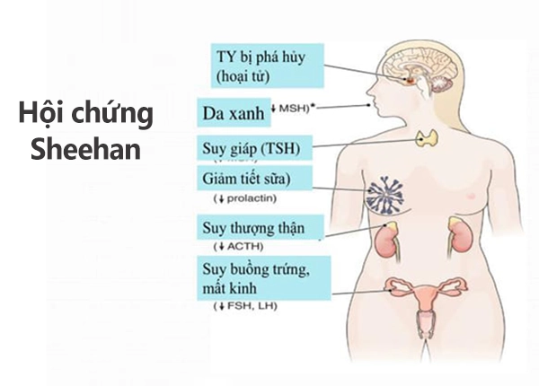 hội chứng Sheehan
