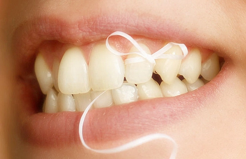 Chỉ nha khoa cần được hạn chế sử dụng khi bạn bị viêm niêm mạc miệng