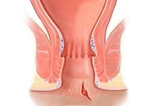 đau hậu môn ở trẻ em