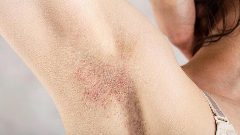 Nhổ lông nách bị viêm