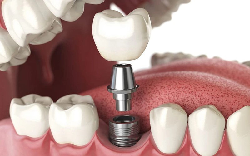 cấy ghép implant