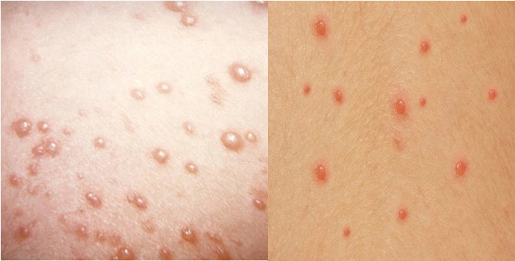 Mụn nước dạng thủy đậu