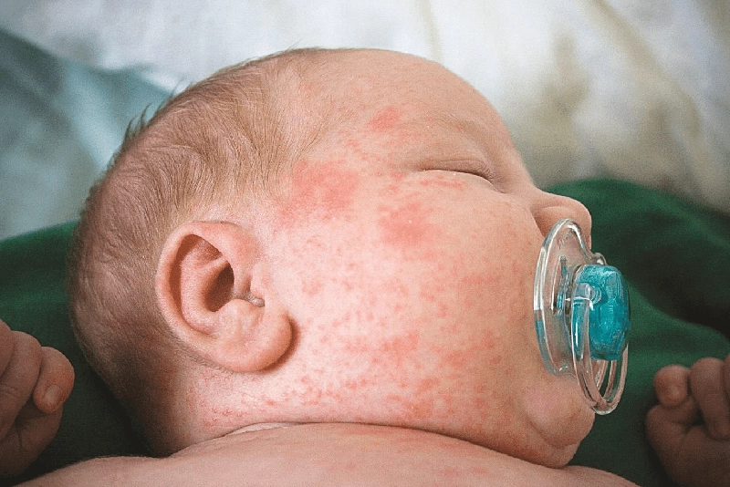 Trong quá trình nuôi dưỡng trẻ có thể mắc bệnh rubella