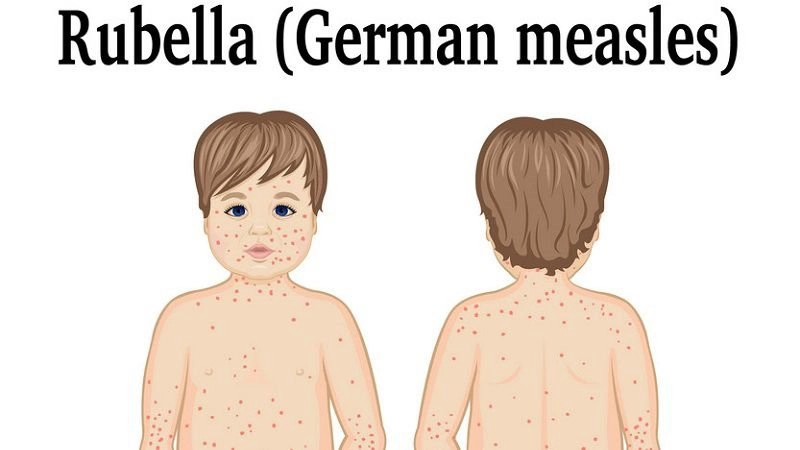 Rubella