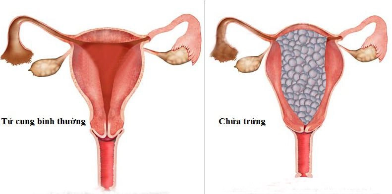 Chửa trứng