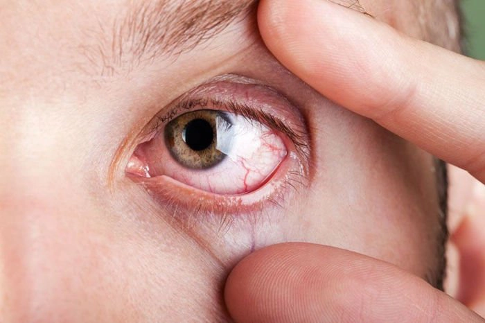 niêm mạc mắt nhợt nhạt