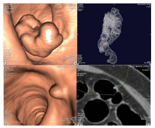 Hình ảnh polyp đại tràng trên nội soi đại tràng ảo