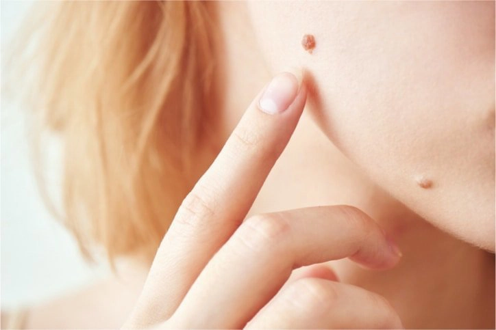da bị nổi cục