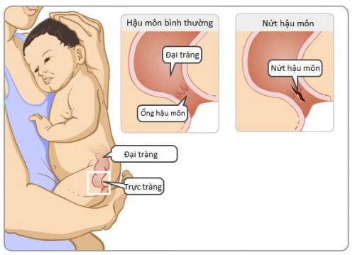 Nứt kẽ hậu môn ở trẻ có đáng lo?