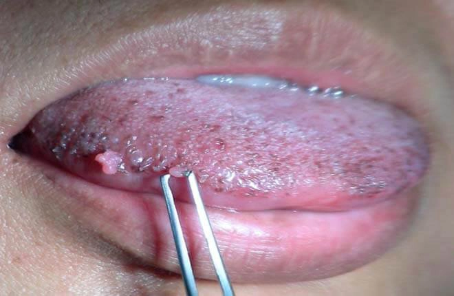 bệnh sùi mào gà ở miệng