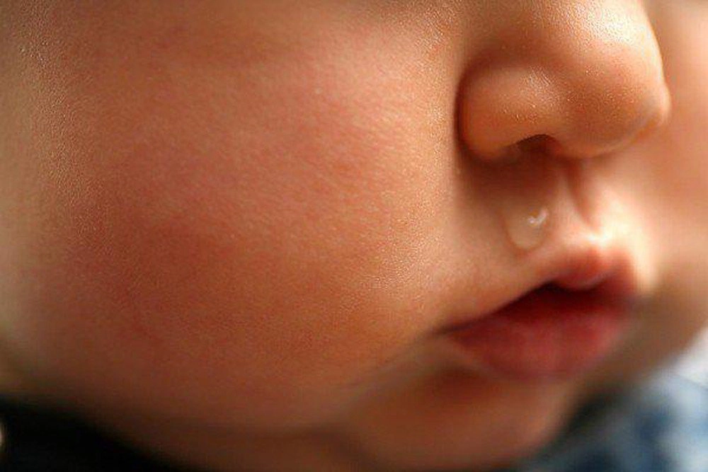 Sổ mũi chảy nước mũi