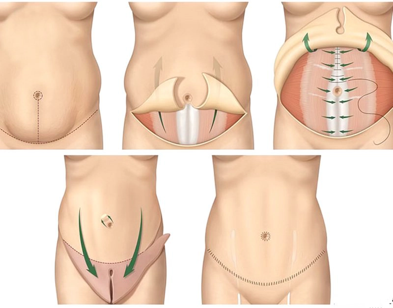 Phẫu thuật căng da bụng sau sinh