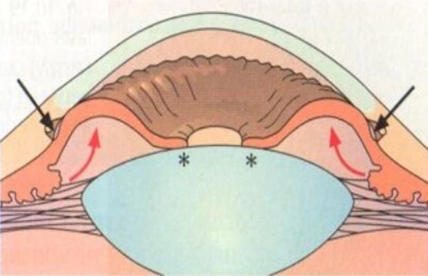 cắt mống mắt chu biên