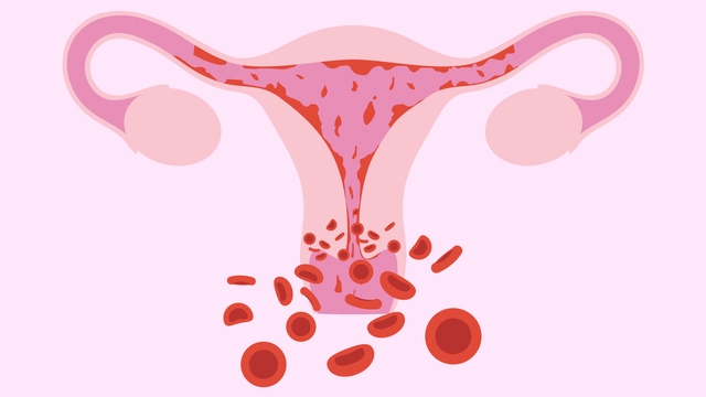 Polyp buồng tử cung