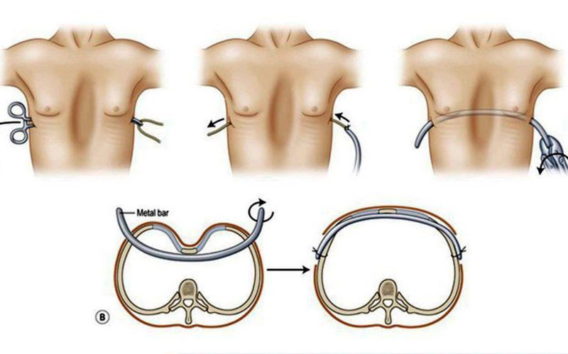 Điều trị lõm ngực bẩm sinh